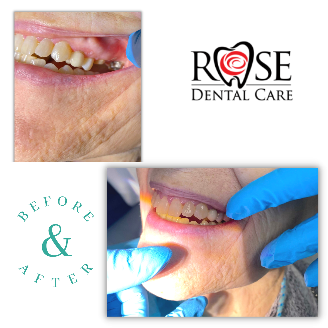 Rose Dental Care- missing teeth