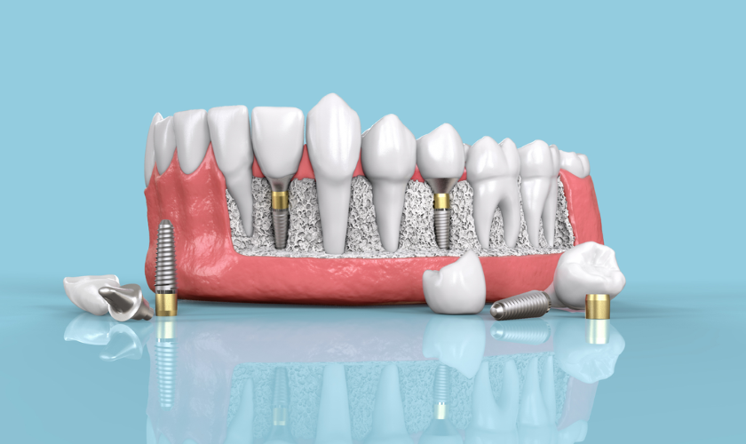 Problem with Dental Implants