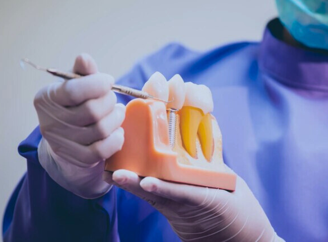 facts to know before getting a dental implant