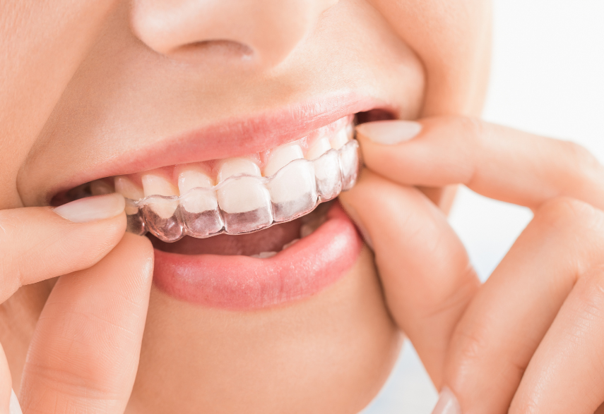 How Does the Invisalign Procedure Operate?