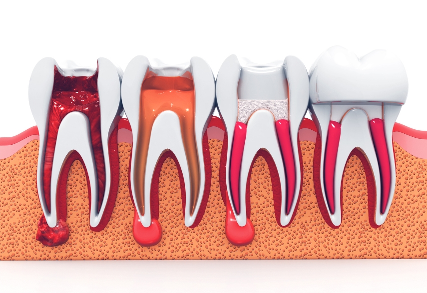 Root Canal Demystified: A Comprehensive Guide For First-Timers